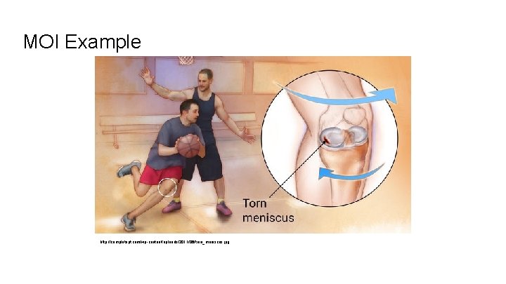 MOI Example http: //completept. com/wp-content/uploads/2011/06/torn_meniscus. jpg 