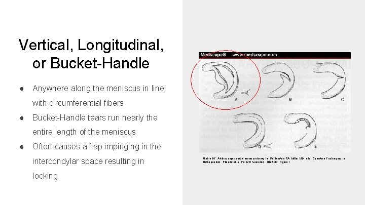 Vertical, Longitudinal, or Bucket-Handle ● Anywhere along the meniscus in line with circumferential fibers