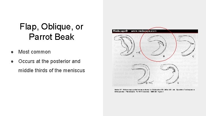 Flap, Oblique, or Parrot Beak ● Most common ● Occurs at the posterior and