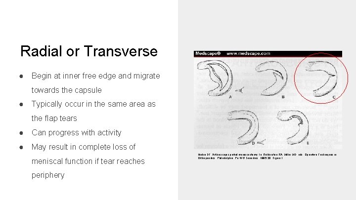 Radial or Transverse ● Begin at inner free edge and migrate towards the capsule