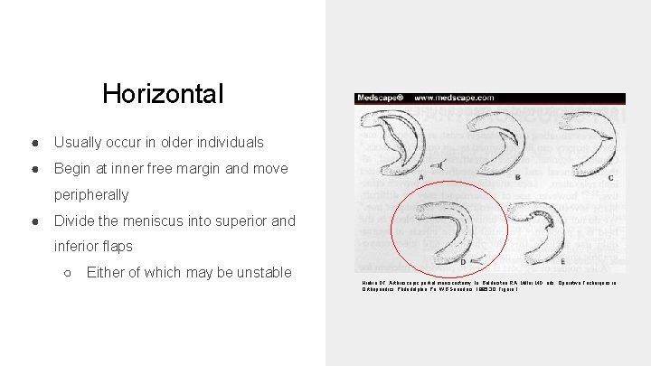 Horizontal ● Usually occur in older individuals ● Begin at inner free margin and