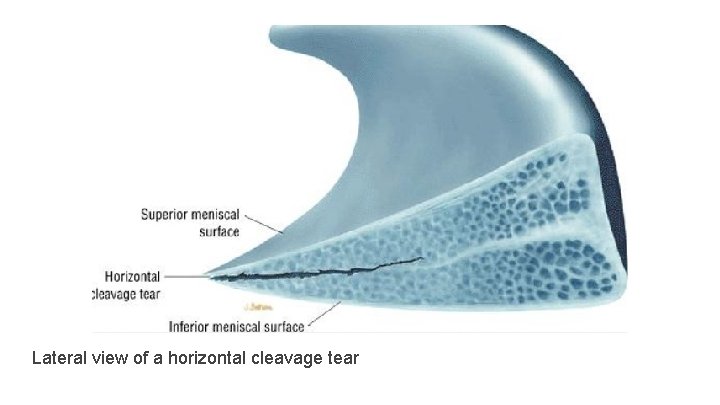 Lateral view of a horizontal cleavage tear 