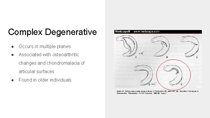 Complex Degenerative ● Occurs in multiple planes ● Associated with osteoarthritic changes and chondromalacia