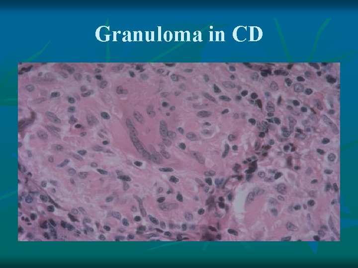 Granuloma in CD 