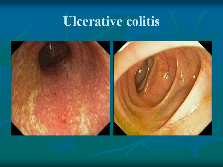 Ulcerative colitis 