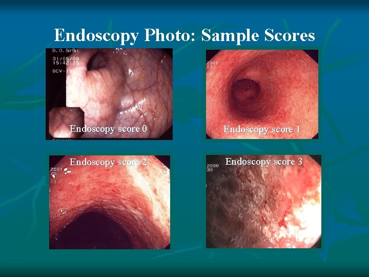 Endoscopy Photo: Sample Scores Endoscopy score 0 Endoscopy score 1 Endoscopy score 2 Endoscopy