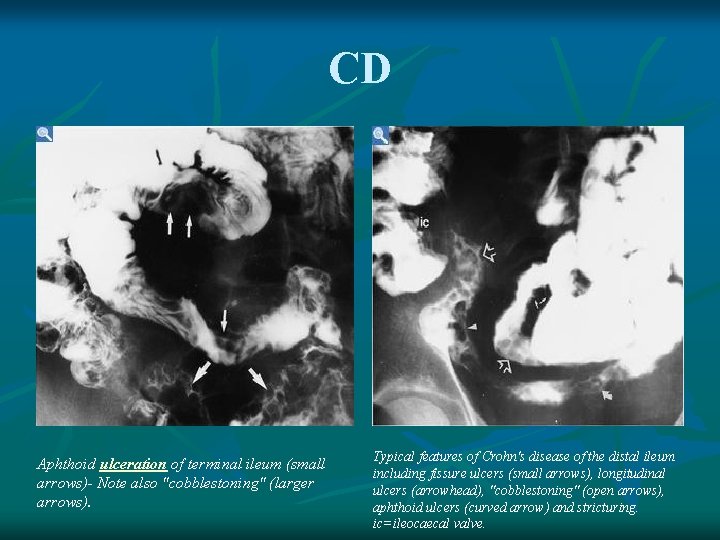 CD Aphthoid ulceration of terminal ileum (small arrows)- Note also "cobblestoning" (larger arrows). Typical