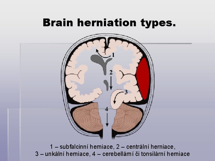 Brain herniation types. 1 – subfalcinní herniace, 2 – centrální herniace, 3 – unkální