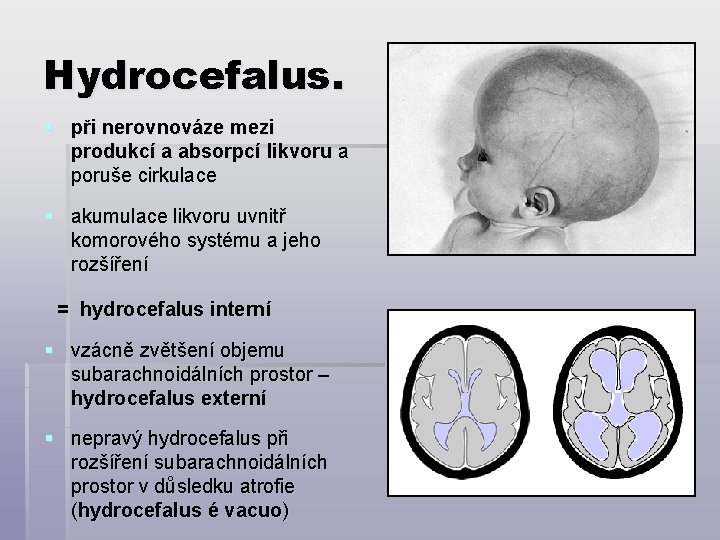 Hydrocefalus. § při nerovnováze mezi produkcí a absorpcí likvoru a poruše cirkulace § akumulace