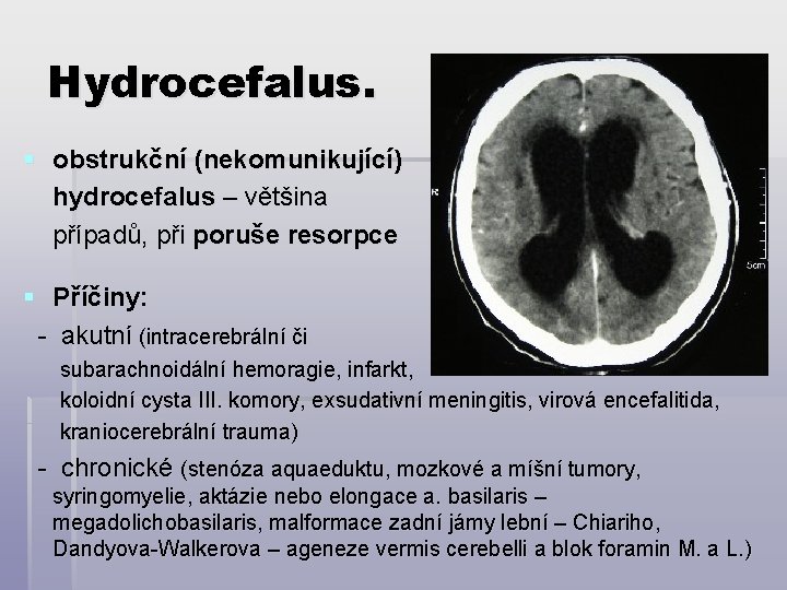 Hydrocefalus. § obstrukční (nekomunikující) hydrocefalus – většina případů, při poruše resorpce § Příčiny: -