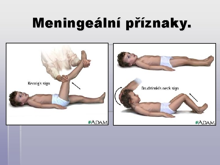 Meningeální příznaky. 