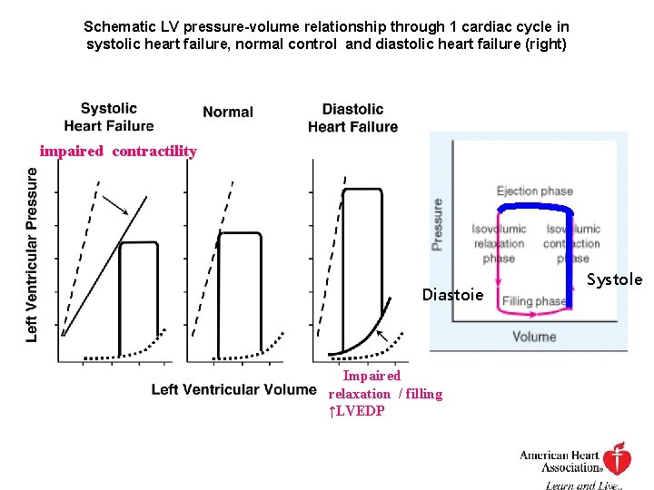 Schematic LV pressure-volume relationship through 1 cardiac cycle in systolic heart failure, normal control