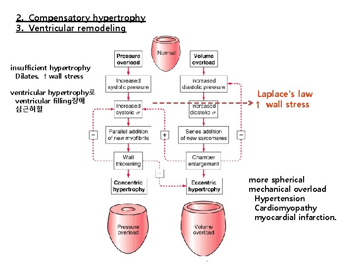 2. Compensatory hypertrophy 3. Ventricular remodeling insufficient hypertrophy Dilates, ↑wall stress ventricular hypertrophy로 ventricular