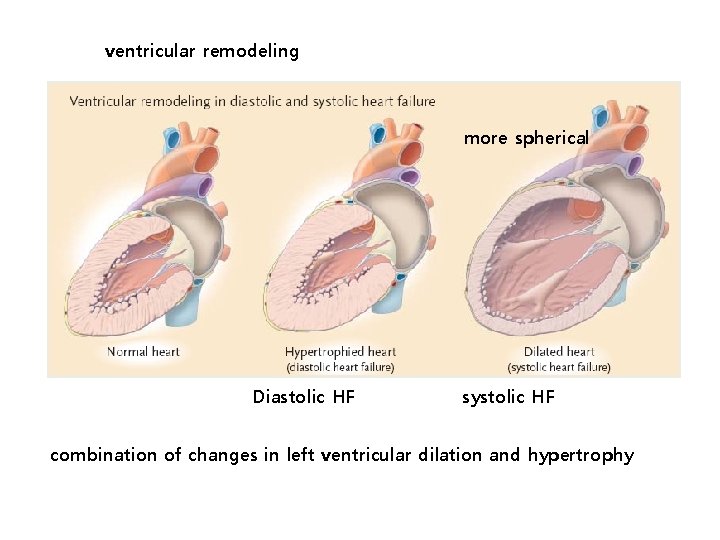 ventricular remodeling more spherical Diastolic HF systolic HF combination of changes in left ventricular