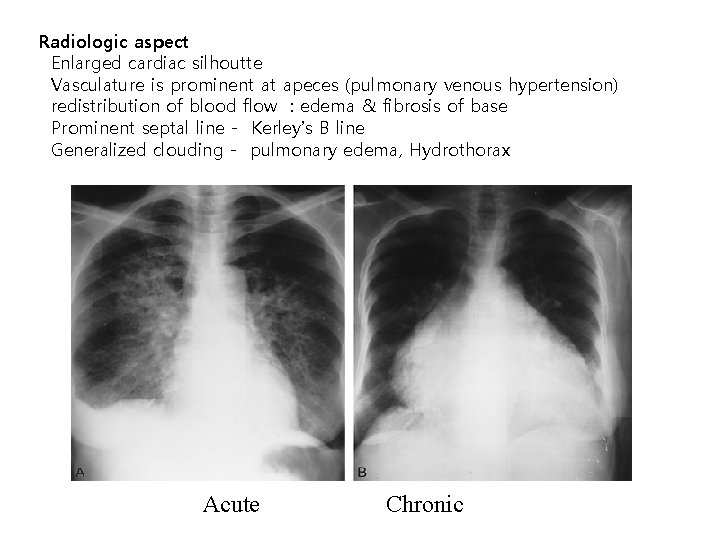 Radiologic aspect Enlarged cardiac silhoutte Vasculature is prominent at apeces (pulmonary venous hypertension) redistribution