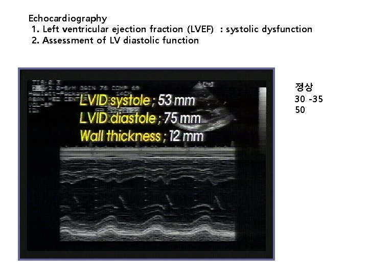 Echocardiography 1. Left ventricular ejection fraction (LVEF) : systolic dysfunction 2. Assessment of LV
