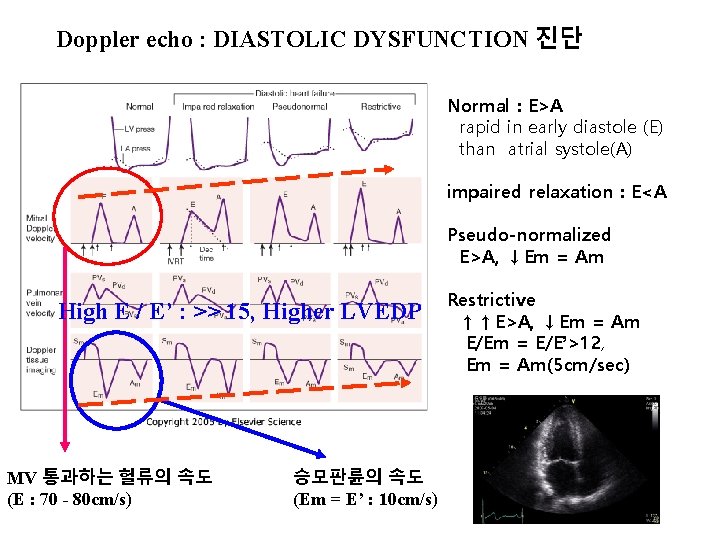Doppler echo : DIASTOLIC DYSFUNCTION 진단 Normal : E>A rapid in early diastole (E)