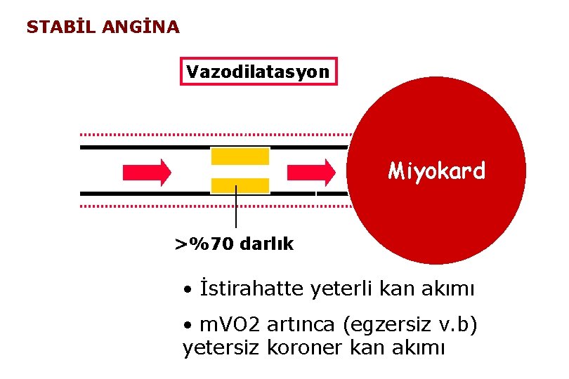 STABİL ANGİNA Vazodilatasyon Miyokard >%70 darlık • İstirahatte yeterli kan akımı • m. VO