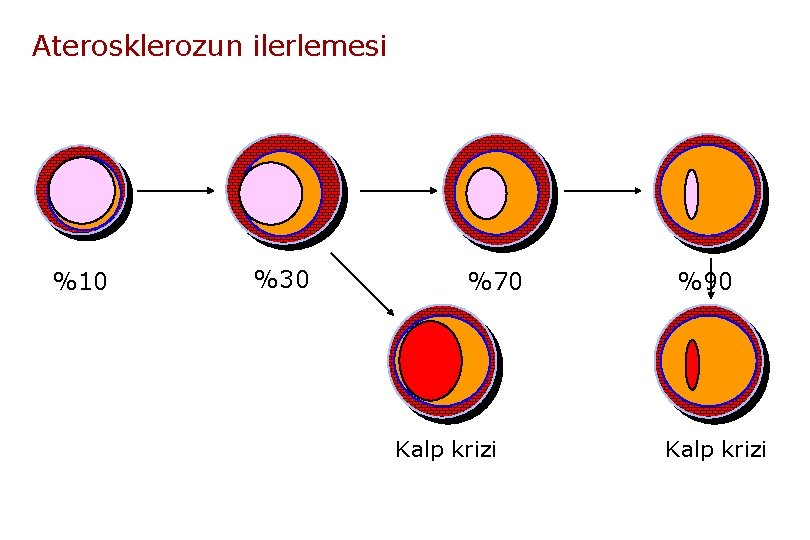 Aterosklerozun ilerlemesi %10 %30 %70 Kalp krizi %90 Kalp krizi 