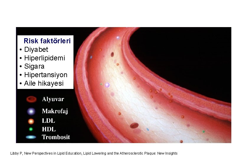 Risk faktörleri • Diyabet • Hiperlipidemi • Sigara • Hipertansiyon • Aile hikayesi Libby