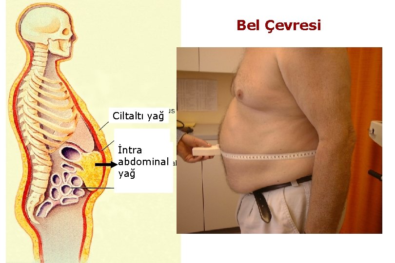 Bel Çevresi Ciltaltı yağ İntra abdominal yağ 