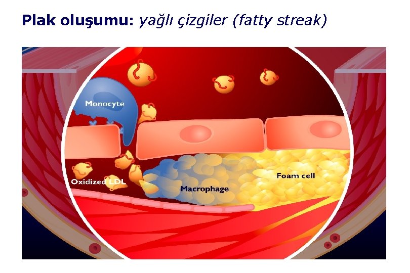 Plak oluşumu: yağlı çizgiler (fatty streak) 