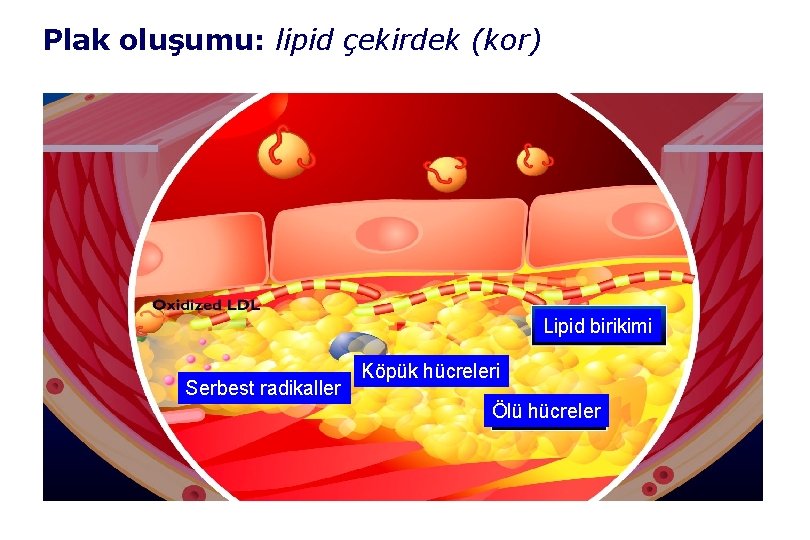Plak oluşumu: lipid çekirdek (kor) Lipid birikimi Serbest radikaller Köpük hücreleri Ölü hücreler 