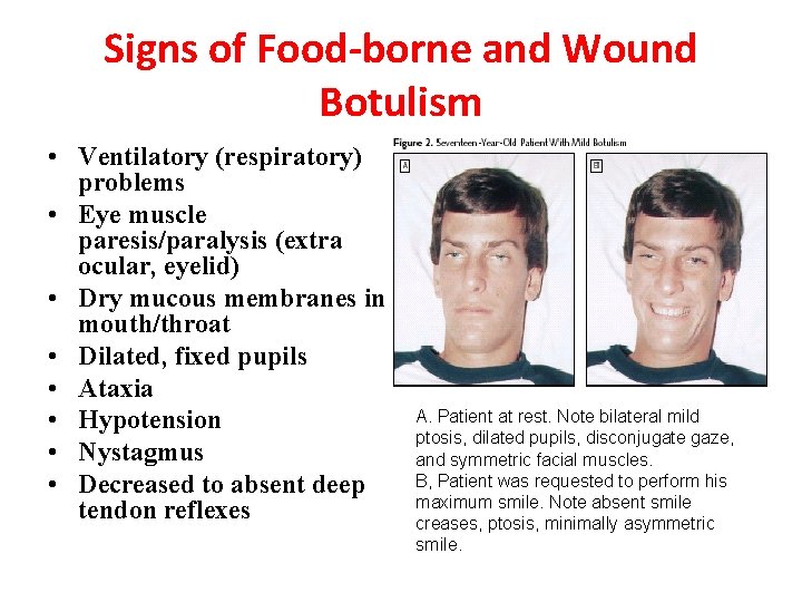 Signs of Food-borne and Wound Botulism • Ventilatory (respiratory) problems • Eye muscle paresis/paralysis
