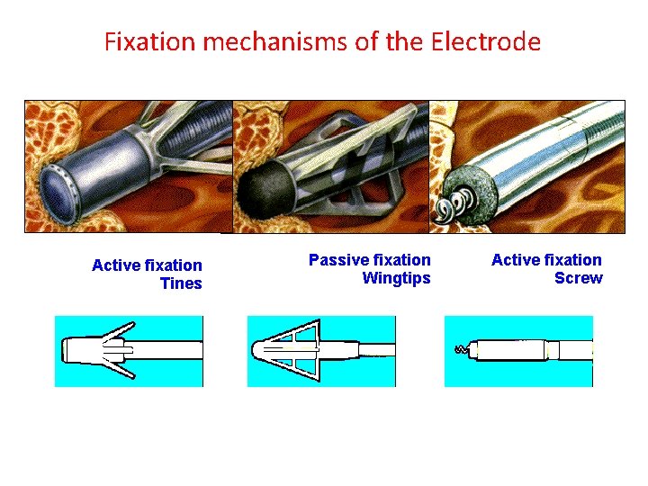 Fixation mechanisms of the Electrode Active fixation Tines Passive fixation Wingtips Active fixation Screw