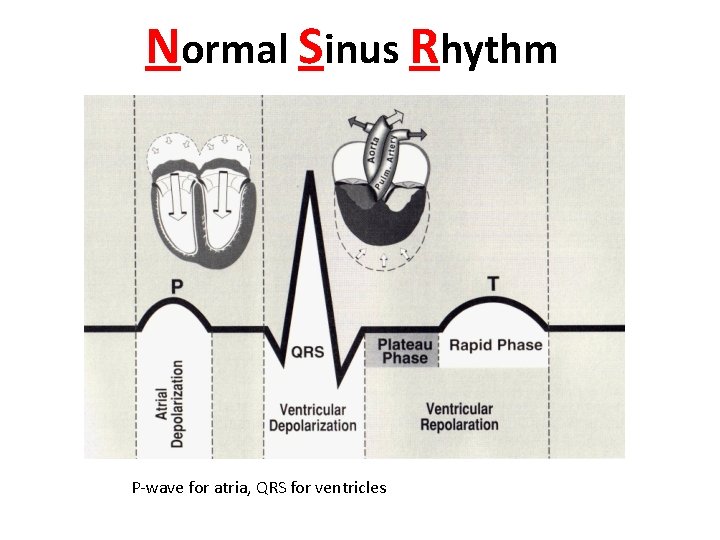 Normal Sinus Rhythm P-wave for atria, QRS for ventricles 
