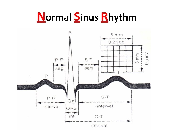 Normal Sinus Rhythm 