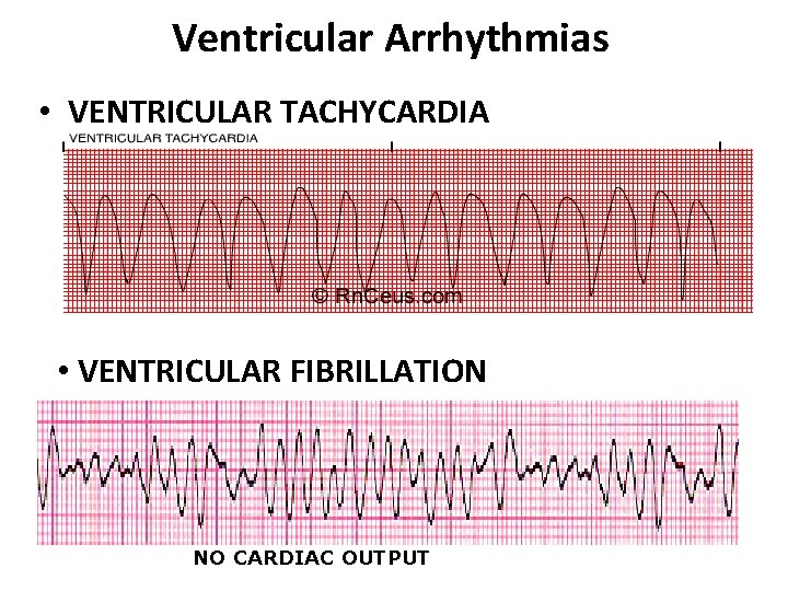 Ventricular Arrhythmias • VENTRICULAR TACHYCARDIA • VENTRICULAR FIBRILLATION NO CARDIAC OUTPUT 