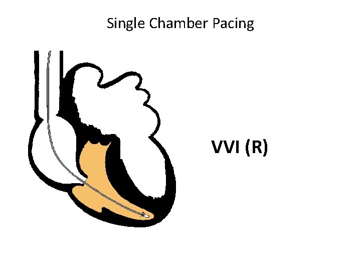 Single Chamber Pacing VVI (R) 