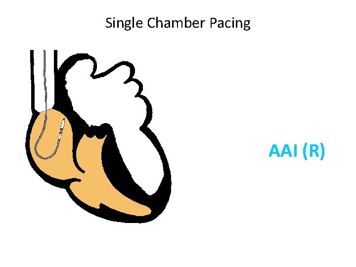 Single Chamber Pacing AAI (R) 