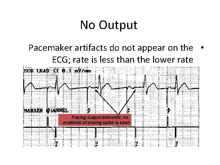 No Output Pacemaker artifacts do not appear on the • ECG; rate is less