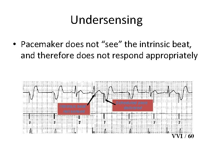 Undersensing • Pacemaker does not “see” the intrinsic beat, and therefore does not respond