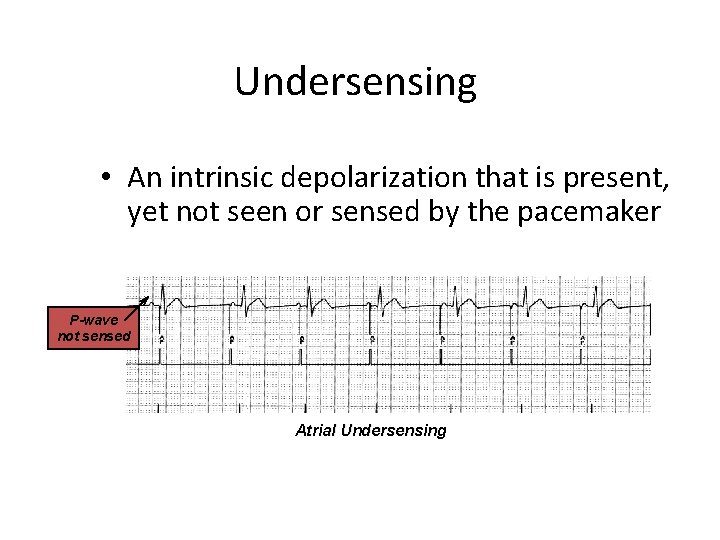 Undersensing • An intrinsic depolarization that is present, yet not seen or sensed by