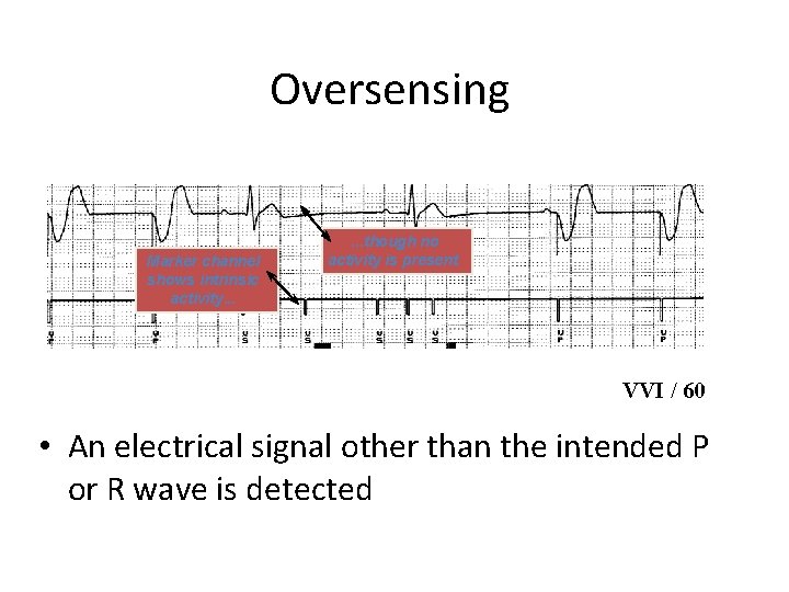Oversensing Marker channel shows intrinsic activity. . . though no activity is present VVI