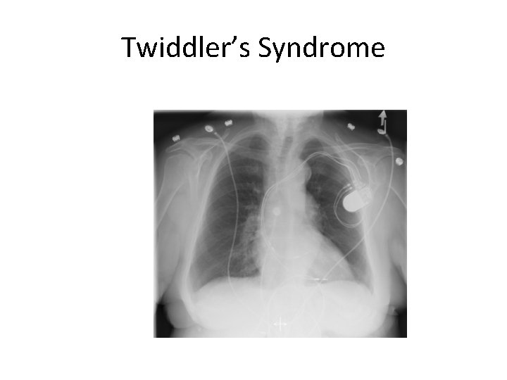 Twiddler’s Syndrome 