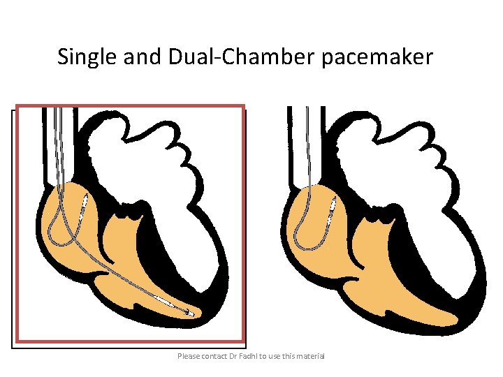 Single and Dual-Chamber pacemaker Please contact Dr Fadhl to use this material 