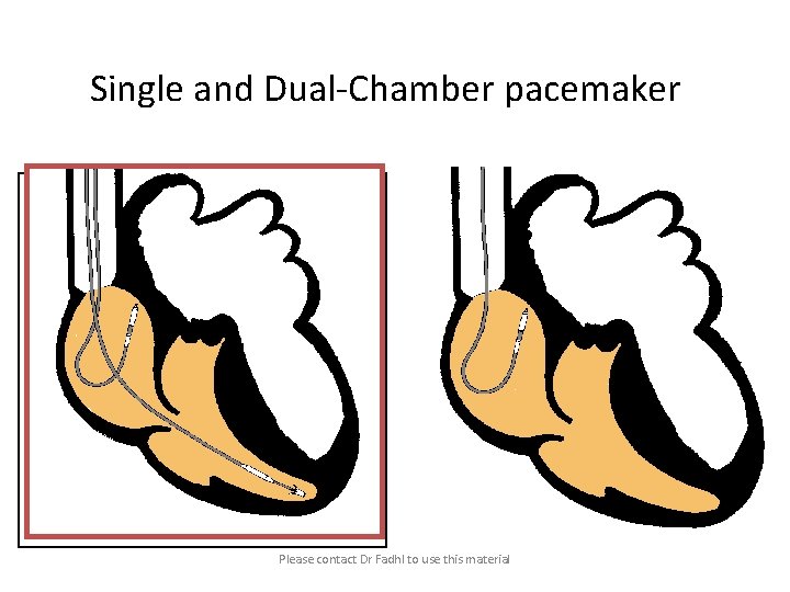 Single and Dual-Chamber pacemaker Please contact Dr Fadhl to use this material 
