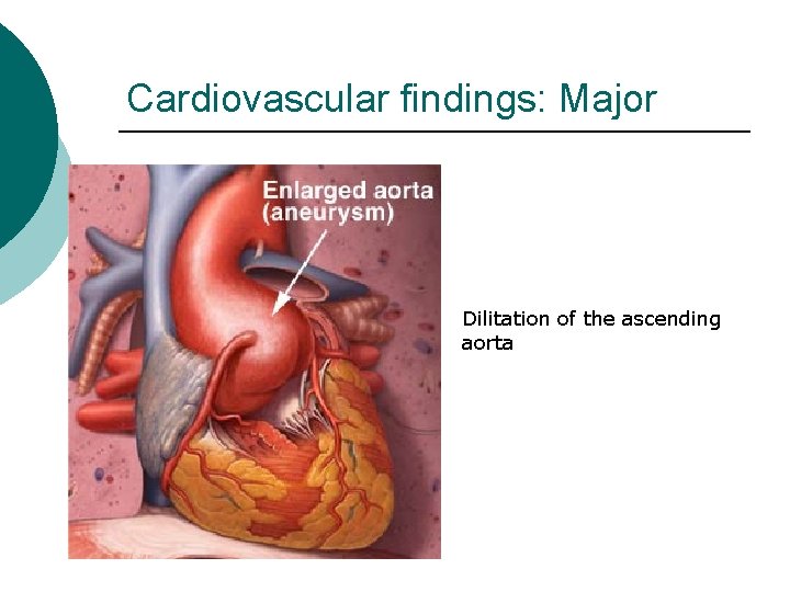Cardiovascular findings: Major Dilitation of the ascending aorta 