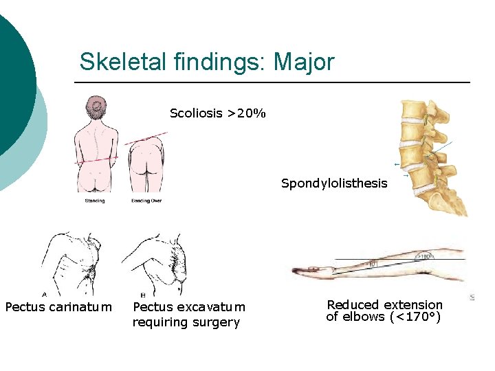 Skeletal findings: Major Scoliosis >20% Spondylolisthesis Pectus carinatum Pectus excavatum requiring surgery Reduced extension