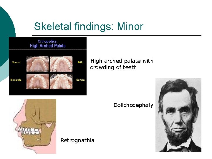 Skeletal findings: Minor High arched palate with crowding of teeth Dolichocephaly Retrognathia 