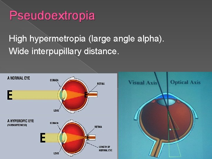 Pseudoextropia High hypermetropia (large angle alpha). Wide interpupillary distance. 