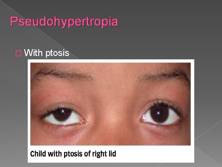 Pseudohypertropia � With ptosis 