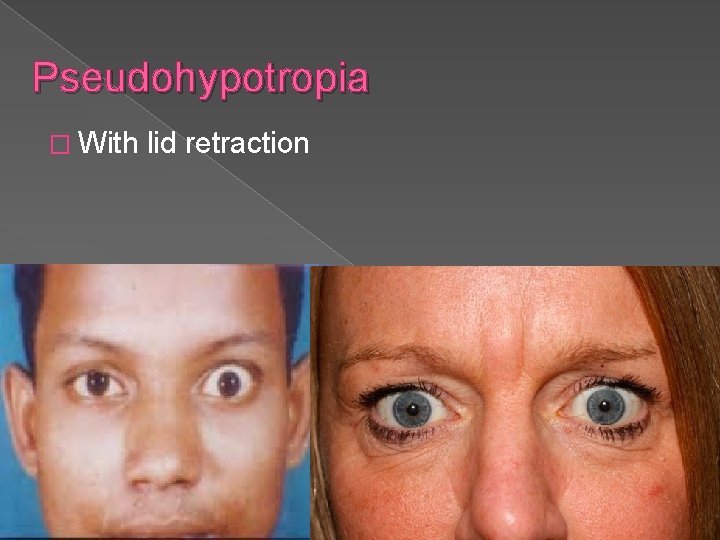 Pseudohypotropia � With lid retraction 