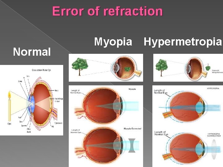 Error of refraction Normal Myopia Hypermetropia 
