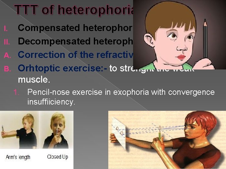 TTT of heterophoria Compensated heterophoria: no TTT. II. Decompensated heterophoria: A. Correction of the
