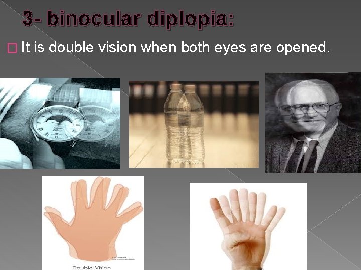 3 - binocular diplopia: � It is double vision when both eyes are opened.